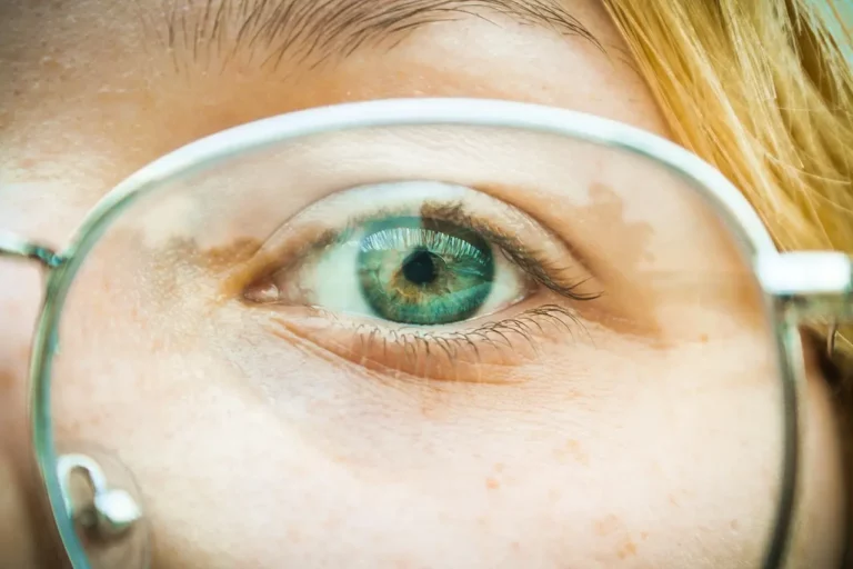 Przekrwione oczy – co należy wiedzieć?